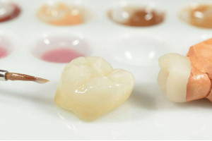 Что такое микропротезирование при лечении зубов? Спросили у стоматолога-терапевта